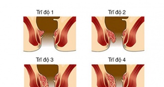 Cách chữa bệnh trĩ nội độ 1, độ 2, độ 3 hiệu quả và an toàn